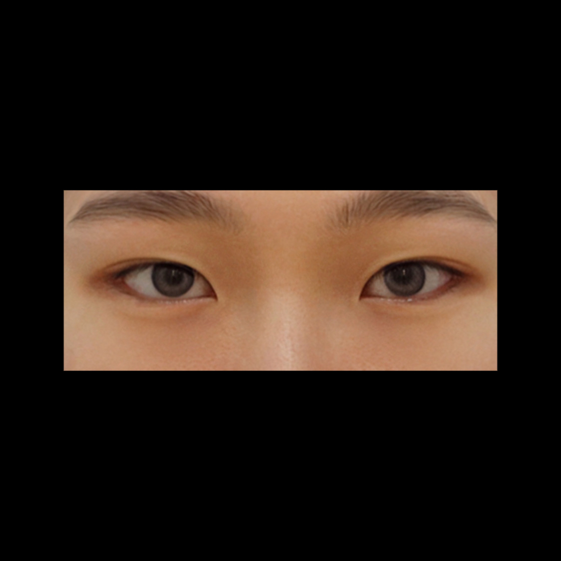 눈재수술 후기