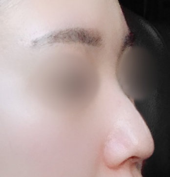 콧대(보형물) 후기