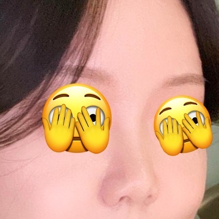 코끝(보형물) 후기