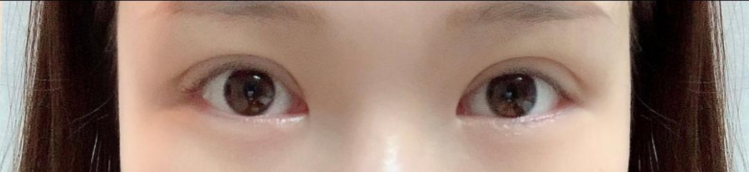 실리프팅 후기