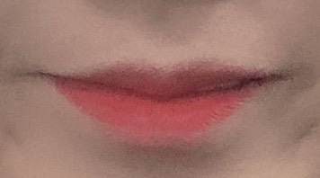 입꼬리성형 후기