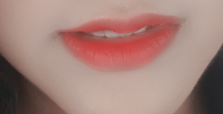 입꼬리성형 후기