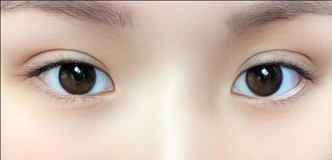 눈재수술 후기