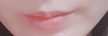 입꼬리성형 후기