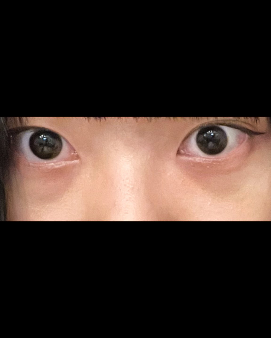 눈밑지방제거 후기