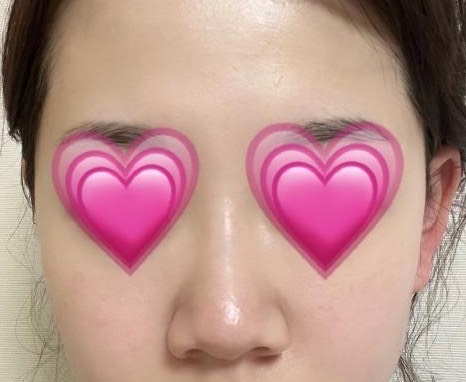 넓은코성형 후기