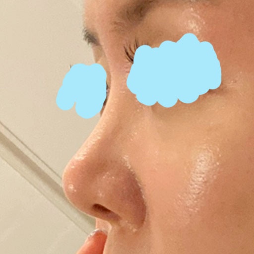 코재수술 후기