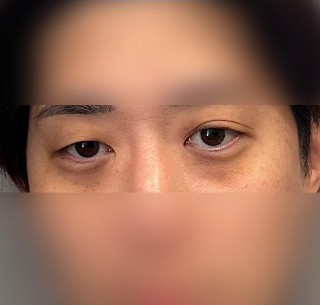 눈밑지방재배치 후기