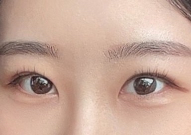 쌍꺼풀(절개) 후기