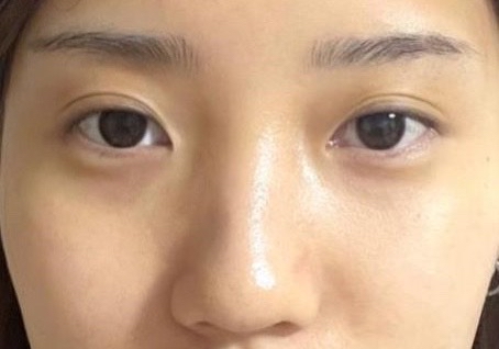 쌍꺼풀(부분절개) 후기