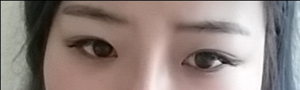 쌍꺼풀(절개) 후기