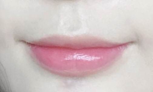 입꼬리성형 후기