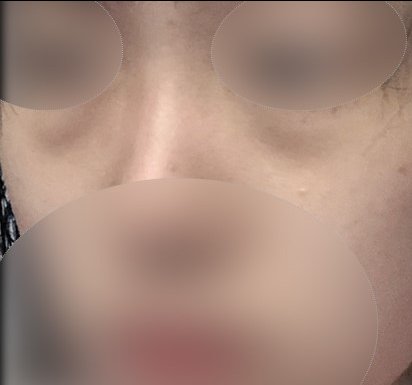 눈밑지방재배치 후기