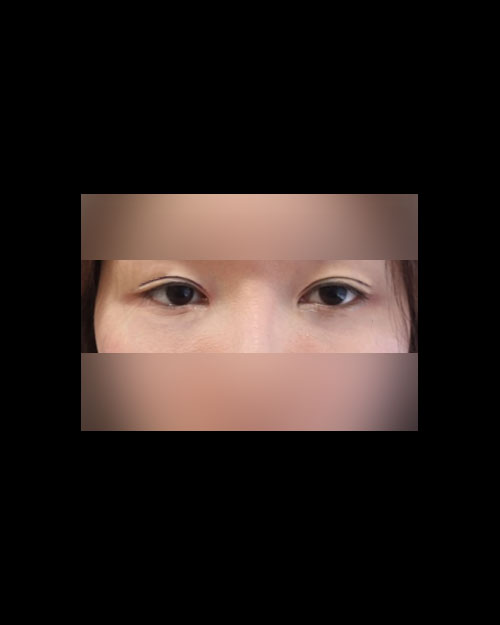 눈재수술 후기