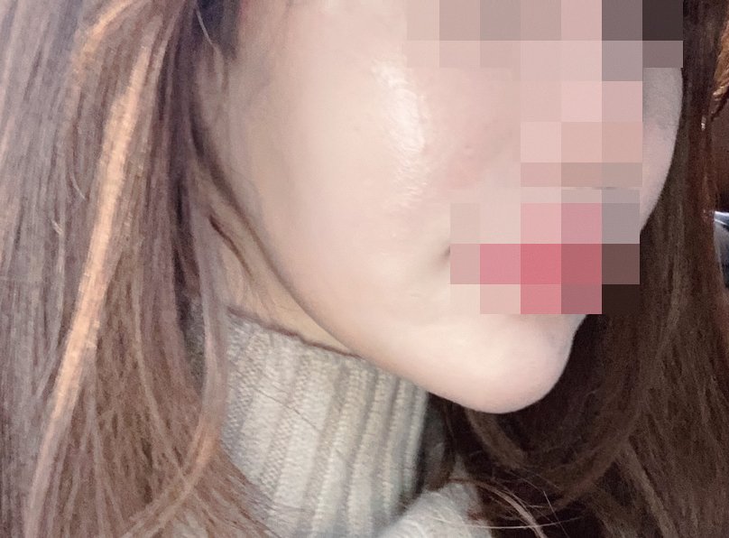 실리프팅 후기