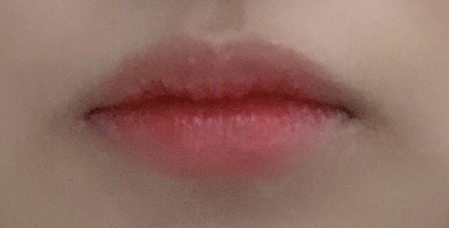 입꼬리성형 후기