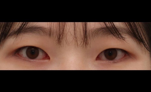 쌍꺼풀(자연유착) 후기