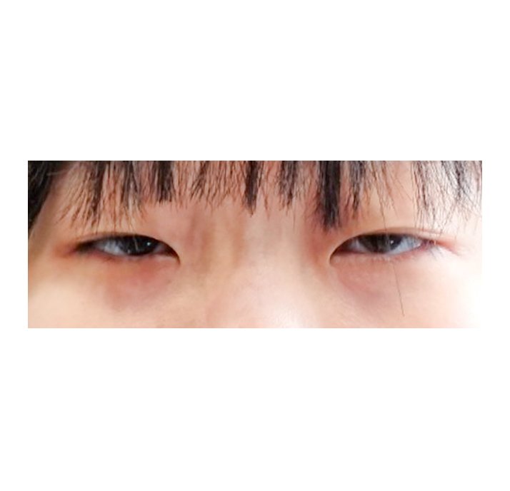 쌍꺼풀(절개) 후기