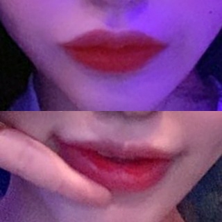 입꼬리성형 후기
