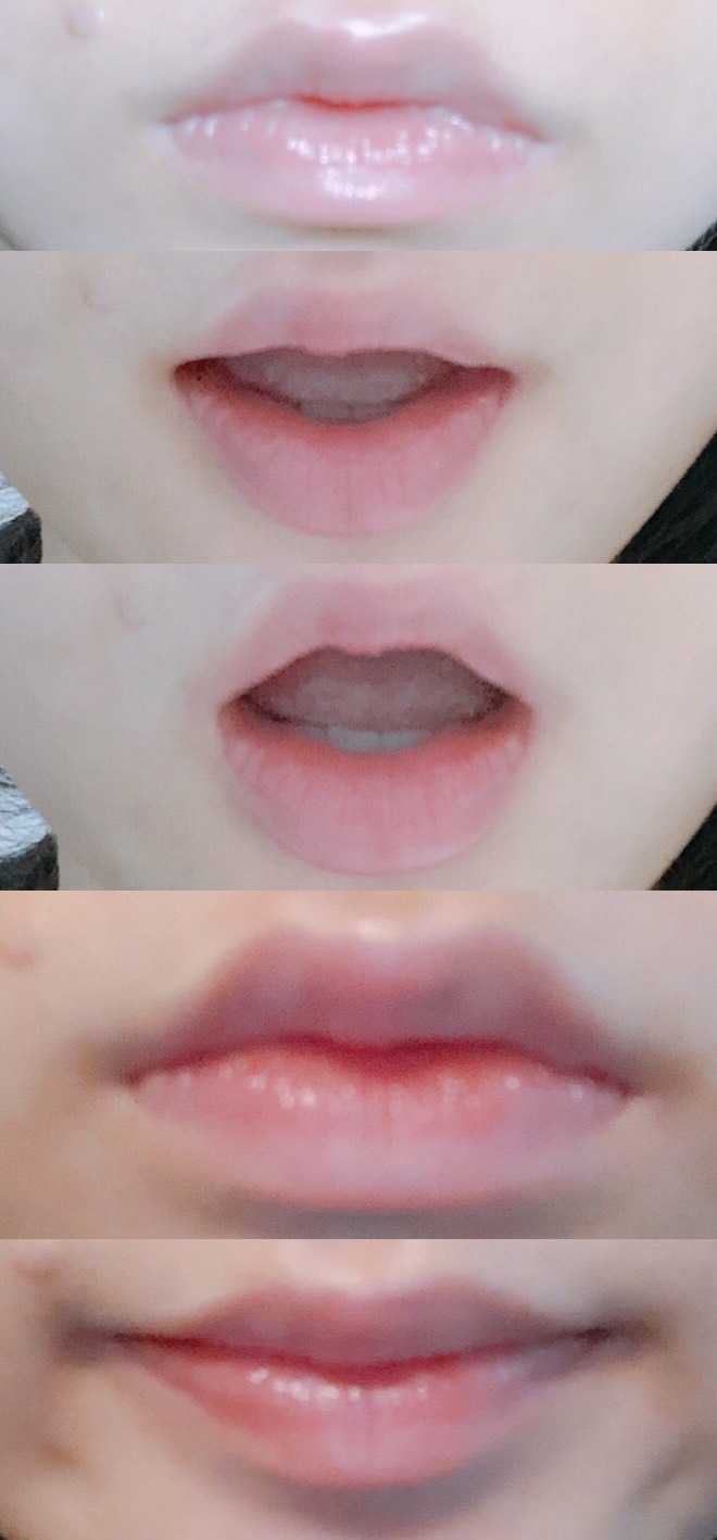 입꼬리성형 후기