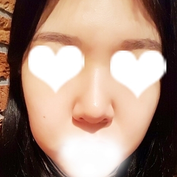코끝(기증연골) 후기