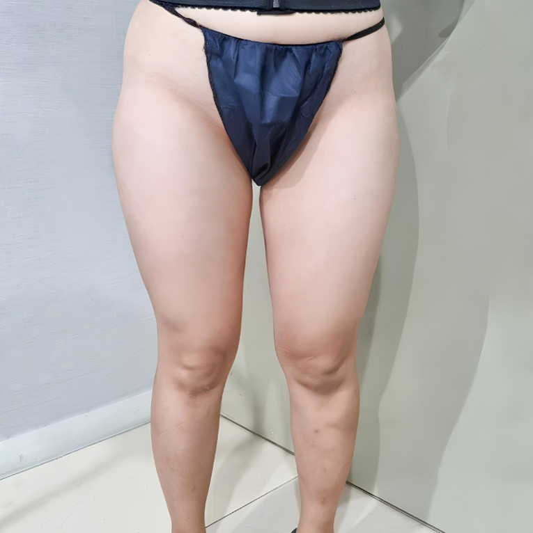 허벅지지방흡입 후기