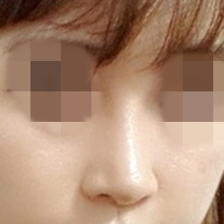 코재수술 후기