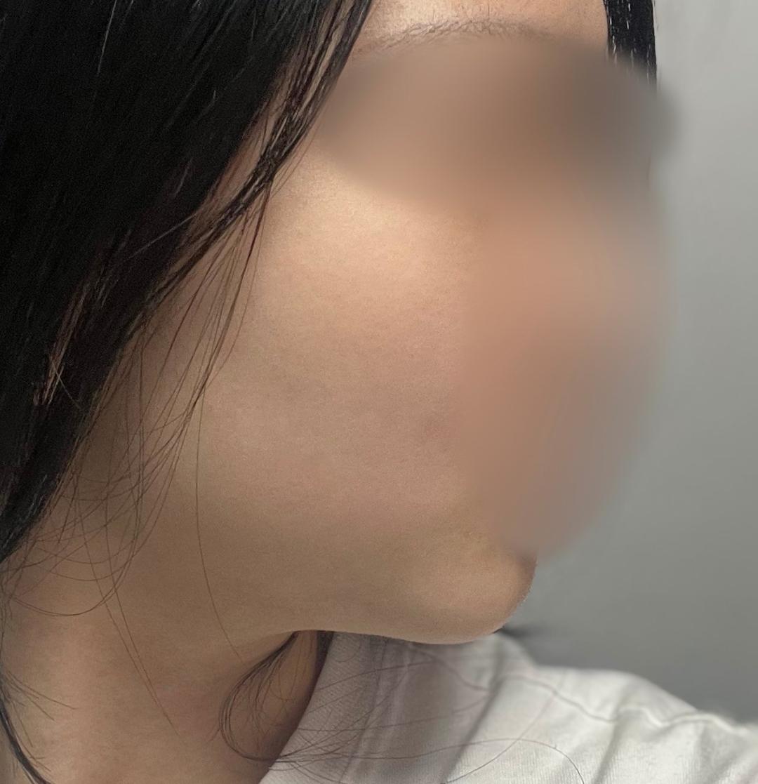 실리프팅 후기