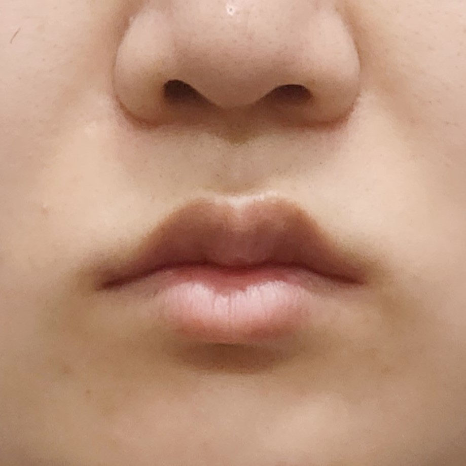 입꼬리성형 후기