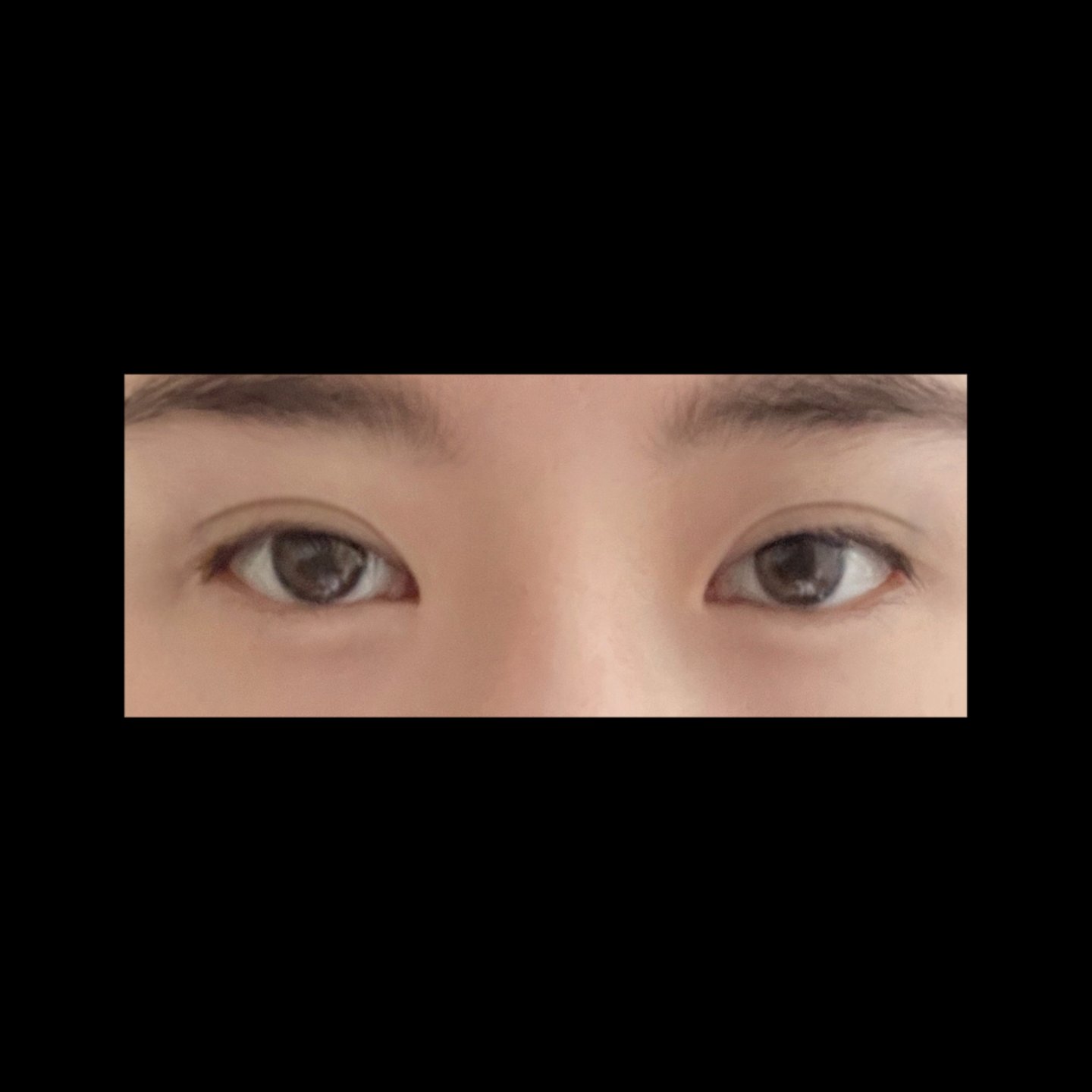 눈재수술 후기
