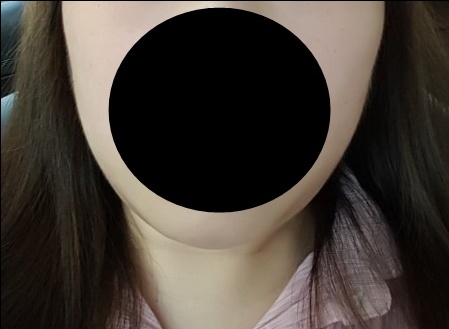 실리프팅 후기