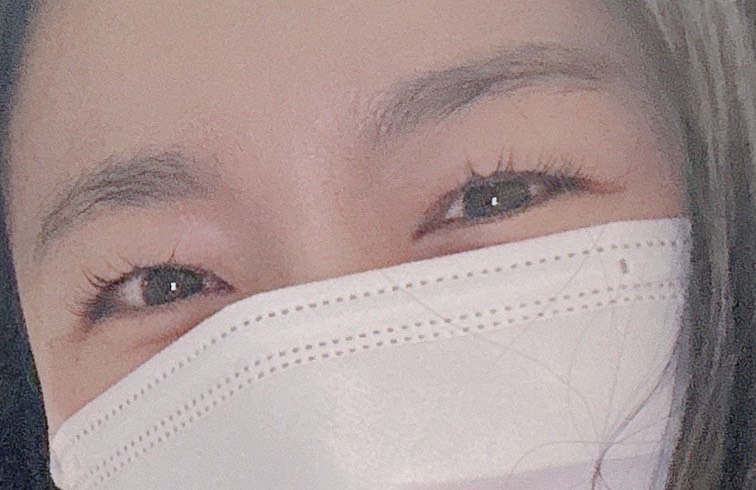 쌍꺼풀(자연유착) 후기