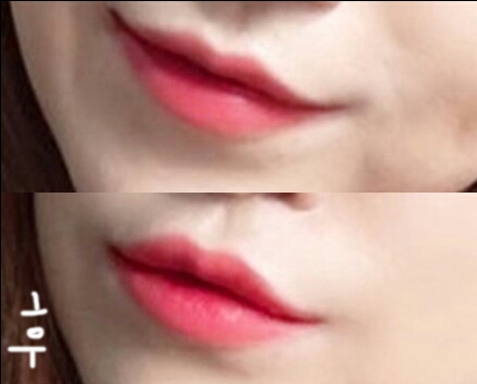 입꼬리성형 후기