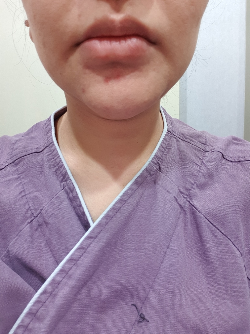 입꼬리성형 후기