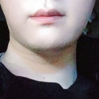 입술축소술 후기