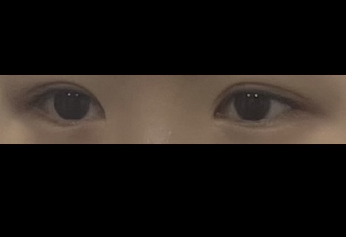 밑트임 후기