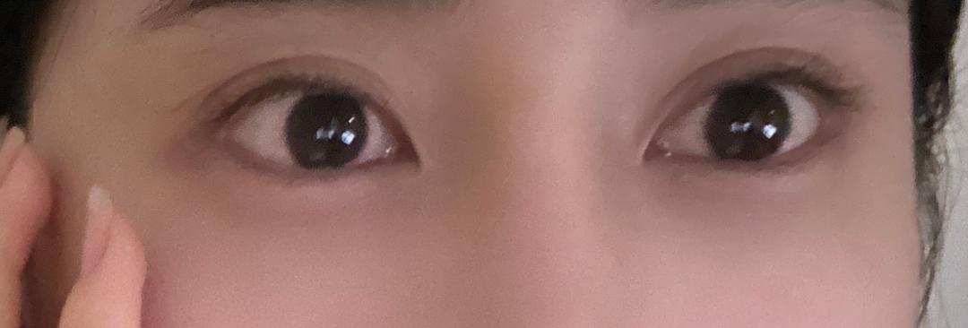 쌍꺼풀(매몰) 후기