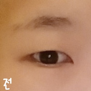 쌍꺼풀(절개) 후기