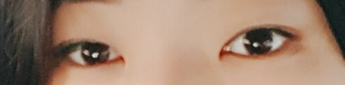 쌍꺼풀(절개) 후기