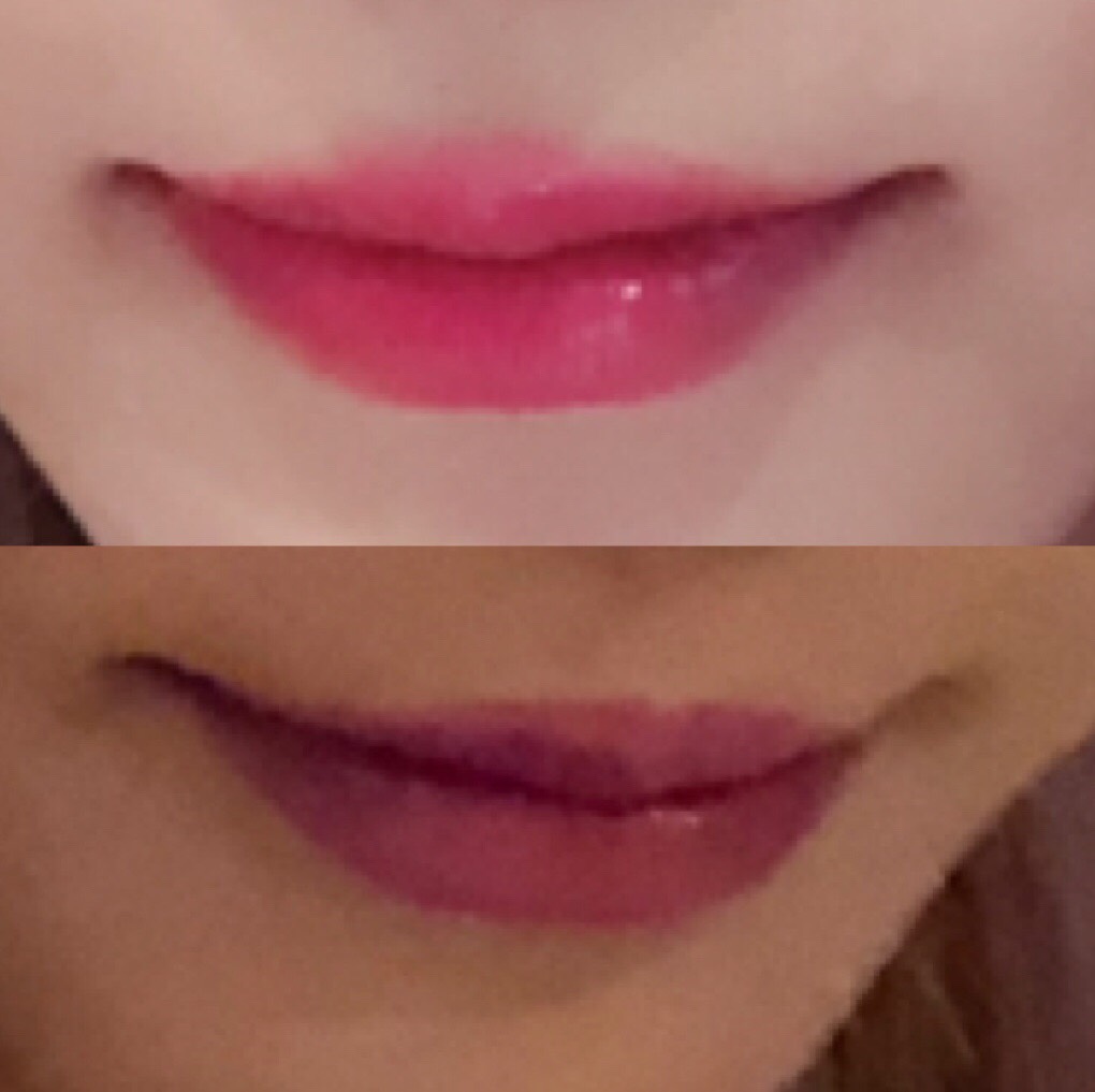 입꼬리성형 후기