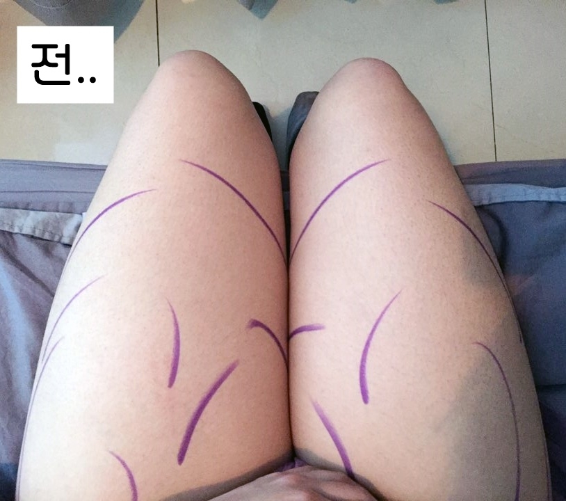 허벅지지방흡입 후기