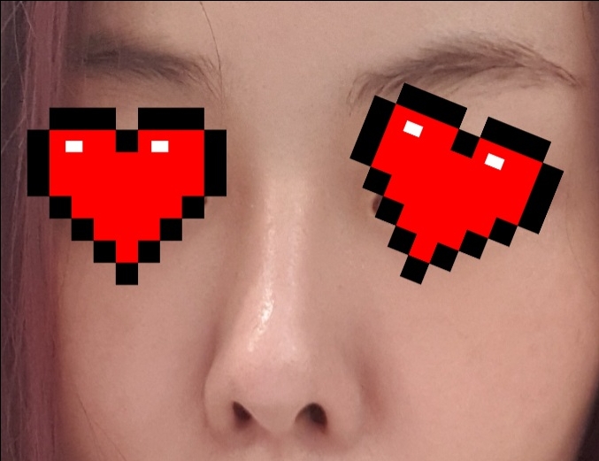 쌍꺼풀(매몰) 후기
