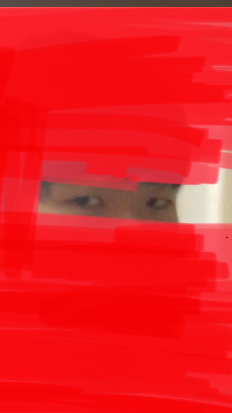 쌍꺼풀(절개) 후기