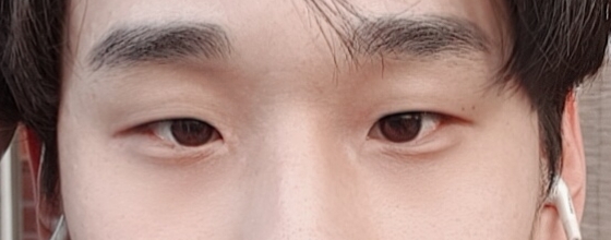 쌍꺼풀(절개) 후기