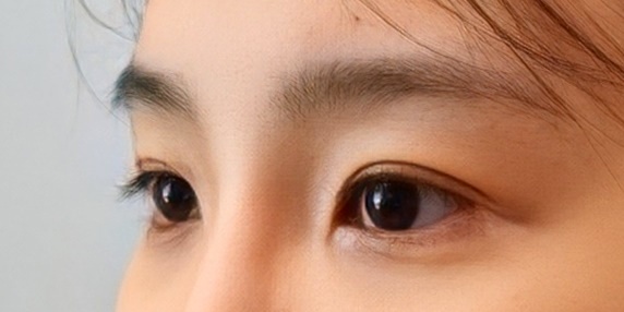 밑트임 후기