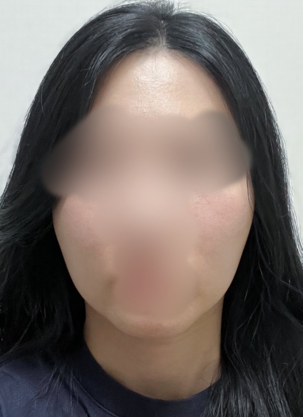 실리프팅 후기
