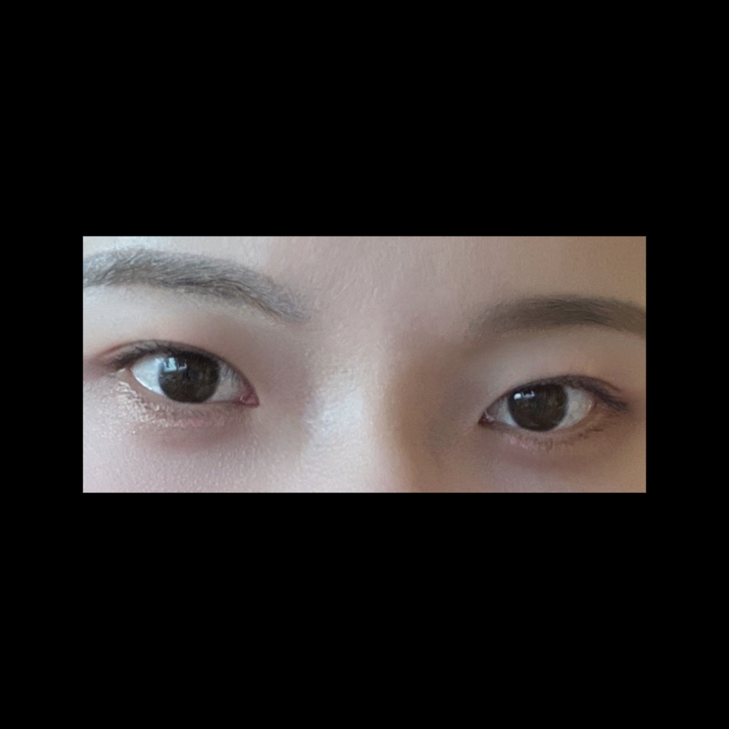 밑트임 후기