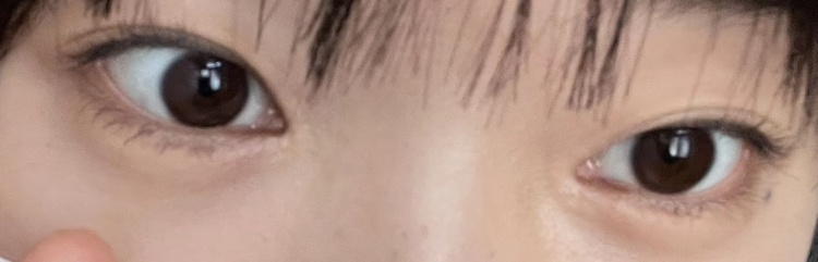 쌍꺼풀(절개) 후기