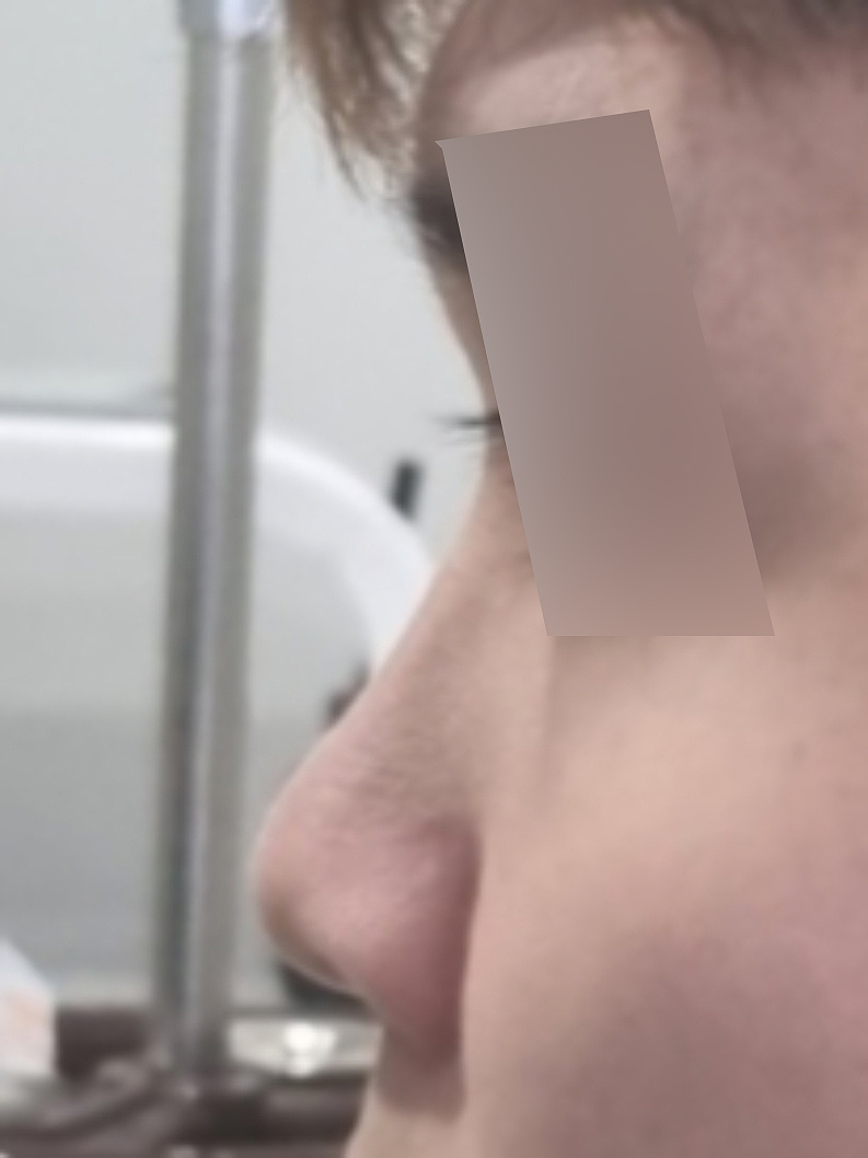 콧대(보형물) 후기