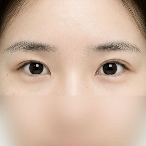 눈재수술 후기